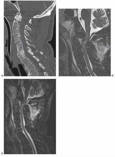 Odontoid Fractures Neupsy Key