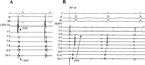 Electrophysiological Breakthroughs From The Left Atrium To The Pulmonary Veins Circulation