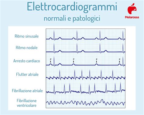 Elettrocardiogramma Che Cos Come Funziona E Cosa Si Vede