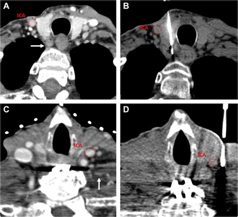 Image Guided Biopsies Of Superficial And Deep Head And Neck And Skull