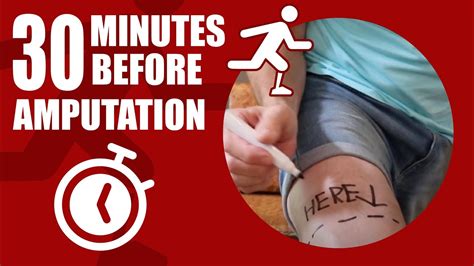 30 Minutes To Amputation Youtube