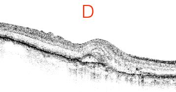 macular-oct-interpretation-D - EyeCarePD