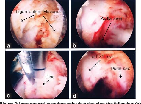 Figure From Endoscopic Discectomy Of L S Disc Herniation Via An