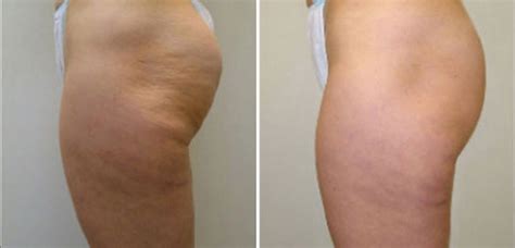 VelaShape III Cellulite Reduction Treatment