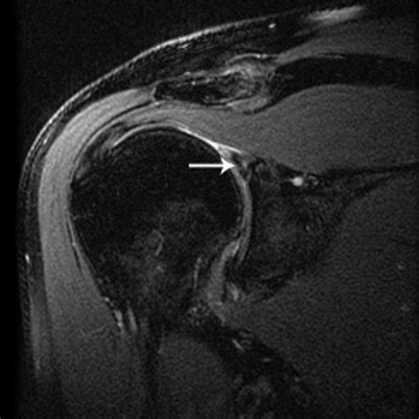 Sensitivity And Specificity In Detection Of Labral Tears With 30 T Mri Of The Shoulder Ajr