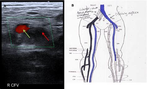 Figure 1 From Iliofemoral Deep Vein Thrombosis Treated By Catheter