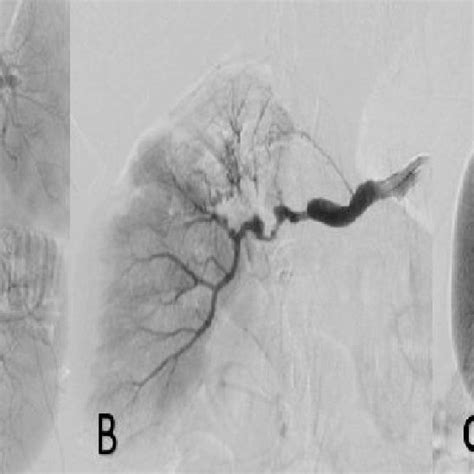 Selective Renal Angiography Views A Two Segments Of The Renal Artery