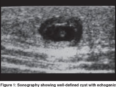 Figure 1 From Subcutaneous And Intramuscular Cysticercosis High