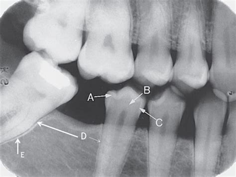 Chapter Normal Landmarks On Intraoral Film Flashcards Quizlet