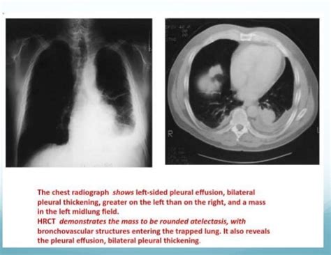 Occupational Lung Disease