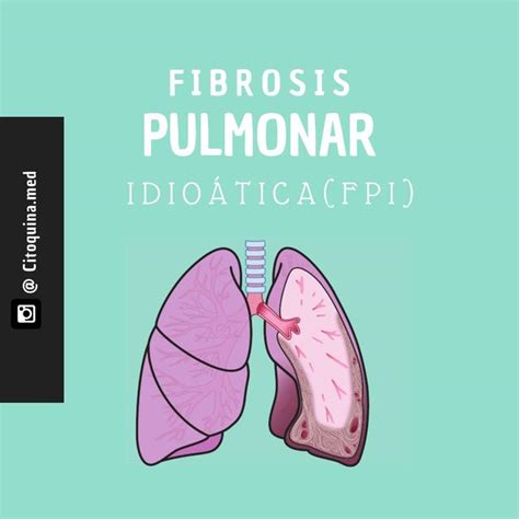 Fibrosis Pulmonar Idiopática CITOQUINA CC uDocz