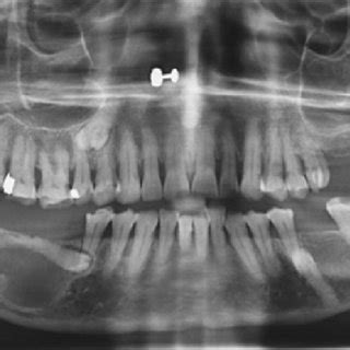 Case Orthopantomograph Showing Welldefined Radiolucency Involving