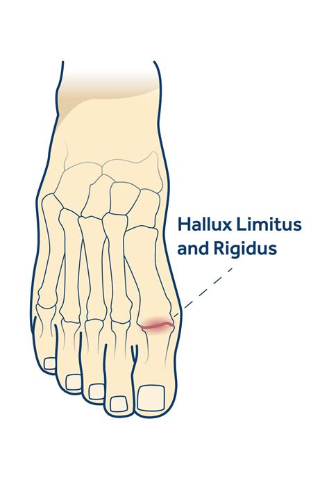 Big Toe Pain Hallux Limitus Rigidus And Rigidus Shellharbour