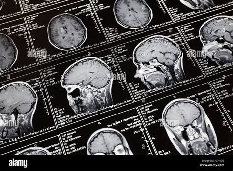 Magnetic Resonance Scan Of The Brain Mri Head Scan Stock Photo Alamy