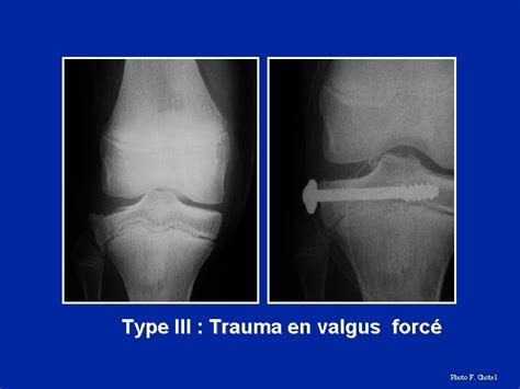 Fractures De Lextrmit Proximale Du Tibia Les Fractures