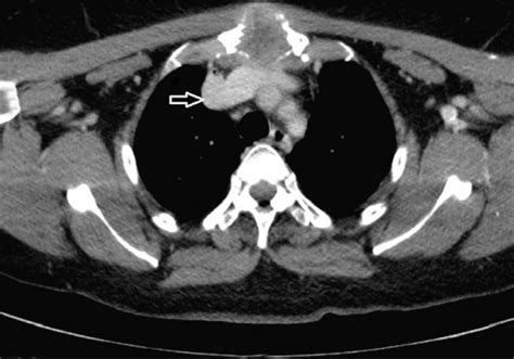 Ct Image Showing Extensive Destruction Of The Manubrium Download Scientific Diagram