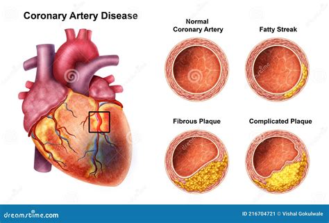 Medizinische Darstellung Der Koronaren Herzkrankheit Stock Abbildung