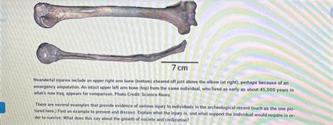 Solved Neandertal Injuries Include An Upper Right Arm Bone Chegg