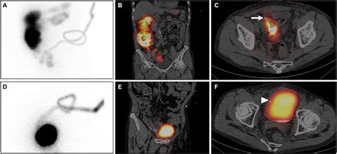 Frontiers Confirmation Of Intestinal And Bladder Perforations In A