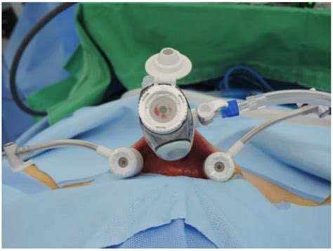 JCM Free Full Text Transoral Endoscopic Thyroidectomy Vestibular