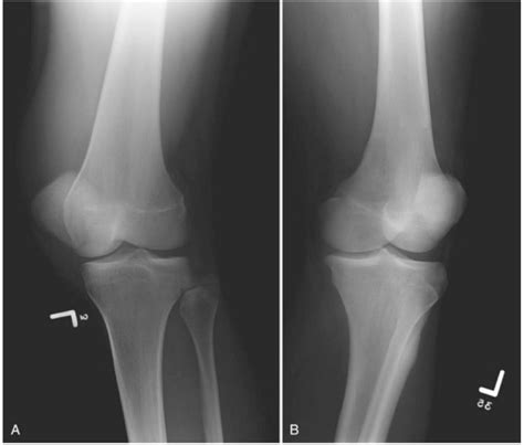 Medial Oblique Knee X Ray