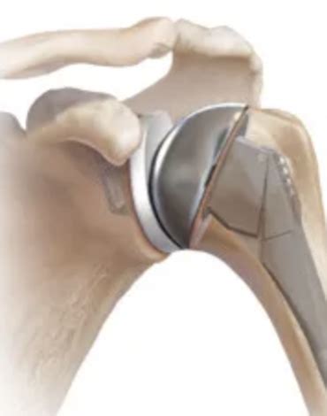 Colocación de prótesis total de Hombro Traumatología y Ortopedia en