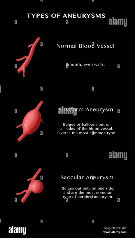 Infographic Comparing A Normal Blood Vessel Top With Two Types Of