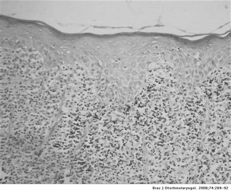 Oral Lichen Planus Clinical And Histopathological Considerations