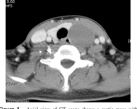 Figure From An Unusual Case Of Bronchogenic Cyst Mimicking Thyroid