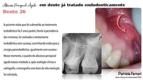 Retratamento Endodôntico Em Dente Já Submetido à Cirurgia Apical