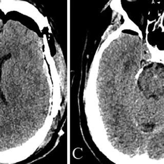 A Axial Head Ct Of A Large Acute Sdh With Midline Shift B Axial Head