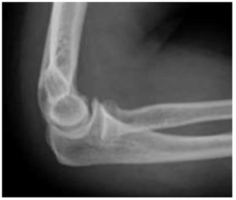 Anterior Elbow Dislocation