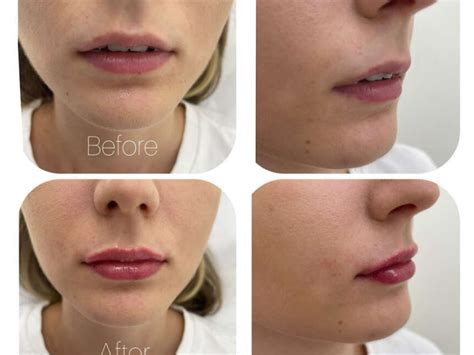 Before And After Derm One Clinic