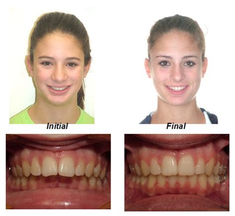 Invisalign Before And After Overjet