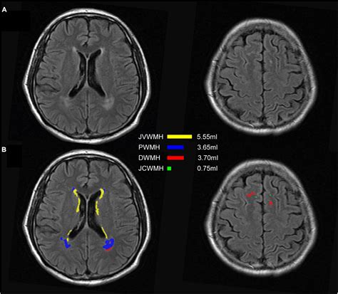 Frontiers Automatic Segmentation Of White Matter Hyperintensities In