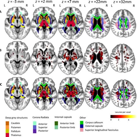 Lacune lesion location map showing spatial distribution throughout the ...