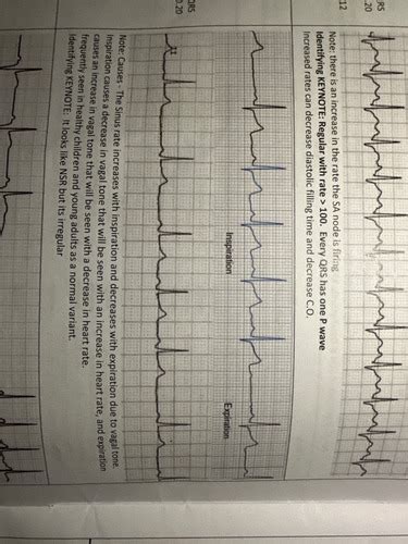 Ekg Exam Flashcards Quizlet