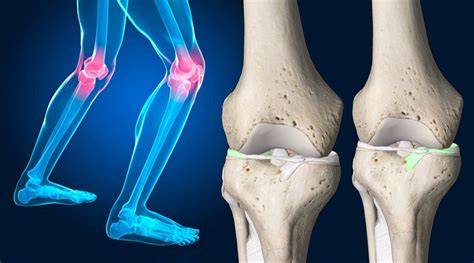 Rotura De Menisco Causas S Ntomas Y Tratamientos