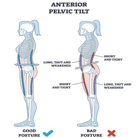 Anterior Pelvic Tilt Exercises For Injuries