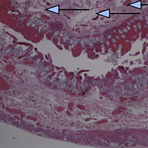 Pdf Small Bowel Lymphangioma Causing Ileo Ileal Intussusception In Adults