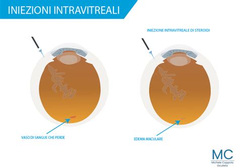 Iniezioni Intravitreali