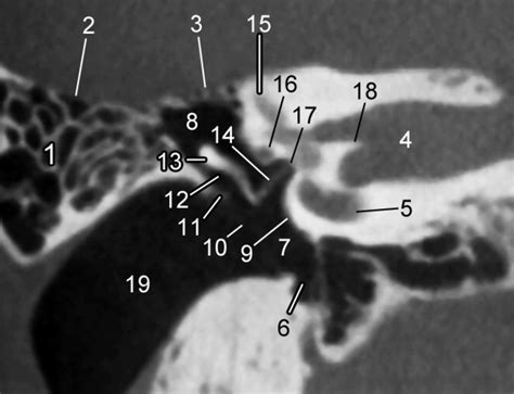 Coronal Ct Image Shows 1 Mastoid Air Cells 2 Tegmen Mastoideum 3