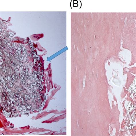 A Gross Appearance Of The Anterior Mitral Leaflet Excised At