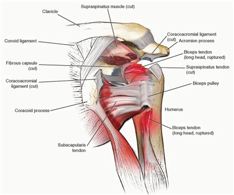 Ultrasound-Guided Injection Technique for Bicipital Tendonitis | Anesthesia Key