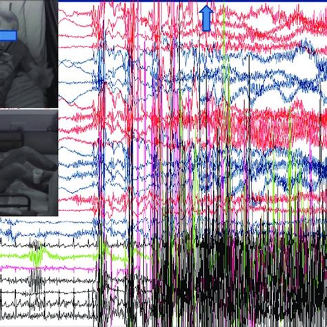 This video-EEG shows the onset of a tonic-clonic seizure (the timing of ...