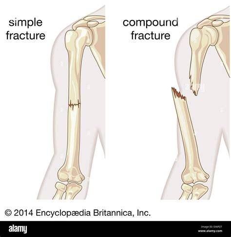 Compound Fracture Diagram