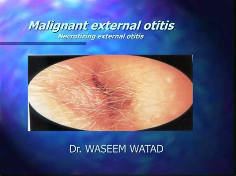 Ppt Malignant External Otitis Necrotizing External Otitis Powerpoint