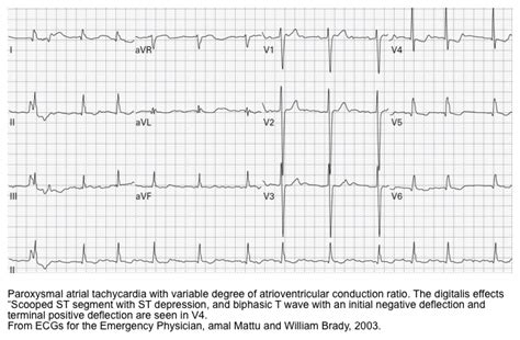 Digoxin Toxicity Recapem