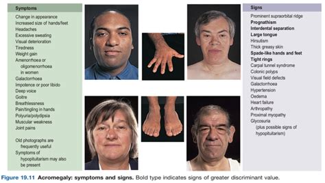 Acromegaly Women