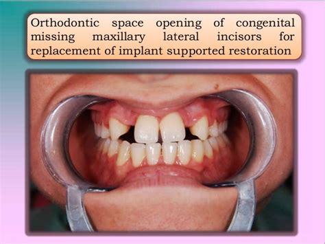 Congenital Missing Lateral Incisors